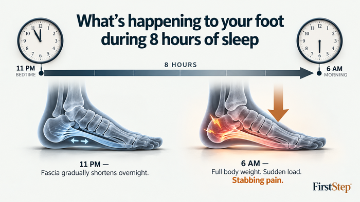 Diagram showing what happens to the plantar fascia during 8 hours of sleep — foot position at 11 PM versus 6 AM.